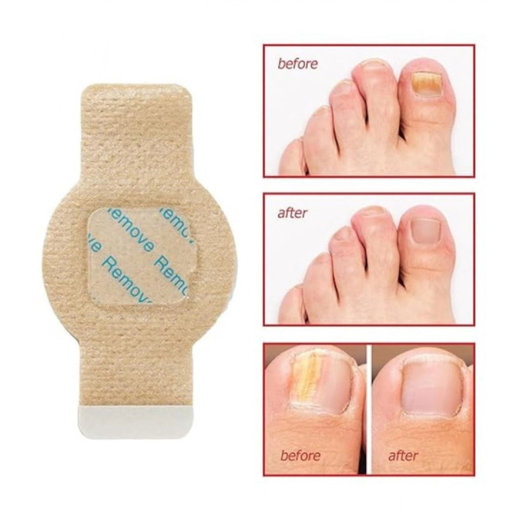 Generic Fungal Nail Patches (Yellow)