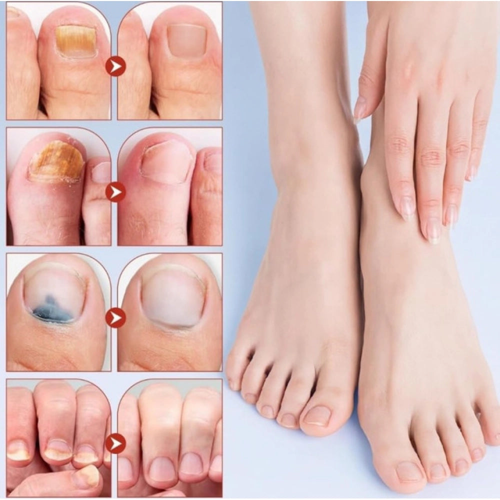 Generic Fungal Nail Patches (Yellow)